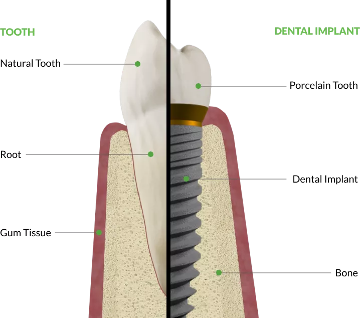what-is-dental-implant