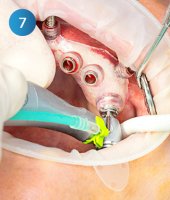 Guided Surgery Alpha Bio Tec