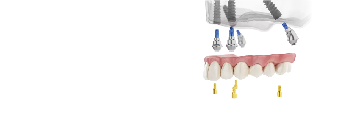 Screw retained restorations IH